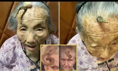 “This is too risky”: 107YO went viral because the 4-inch “Longevity Horn” growing on her forehead was said to be due to… see more