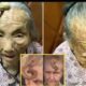 “This is too risky”: 107YO went viral because the 4-inch “Longevity Horn” growing on her forehead was said to be due to… see more